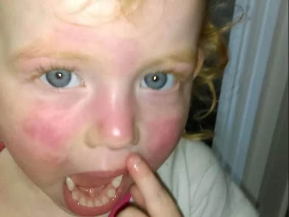 Martha Byrnes face was covered in a painful rash after using the wipes