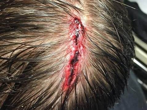 Daniel Peters' head wound, which his mum says was sustained in the attack in Conisbrough