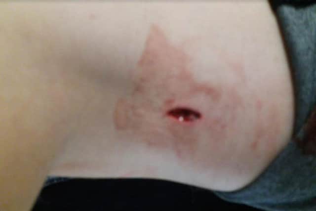 Brandon Reilly's stab wound, which his mum says was sustained in the attack in Conisbrough